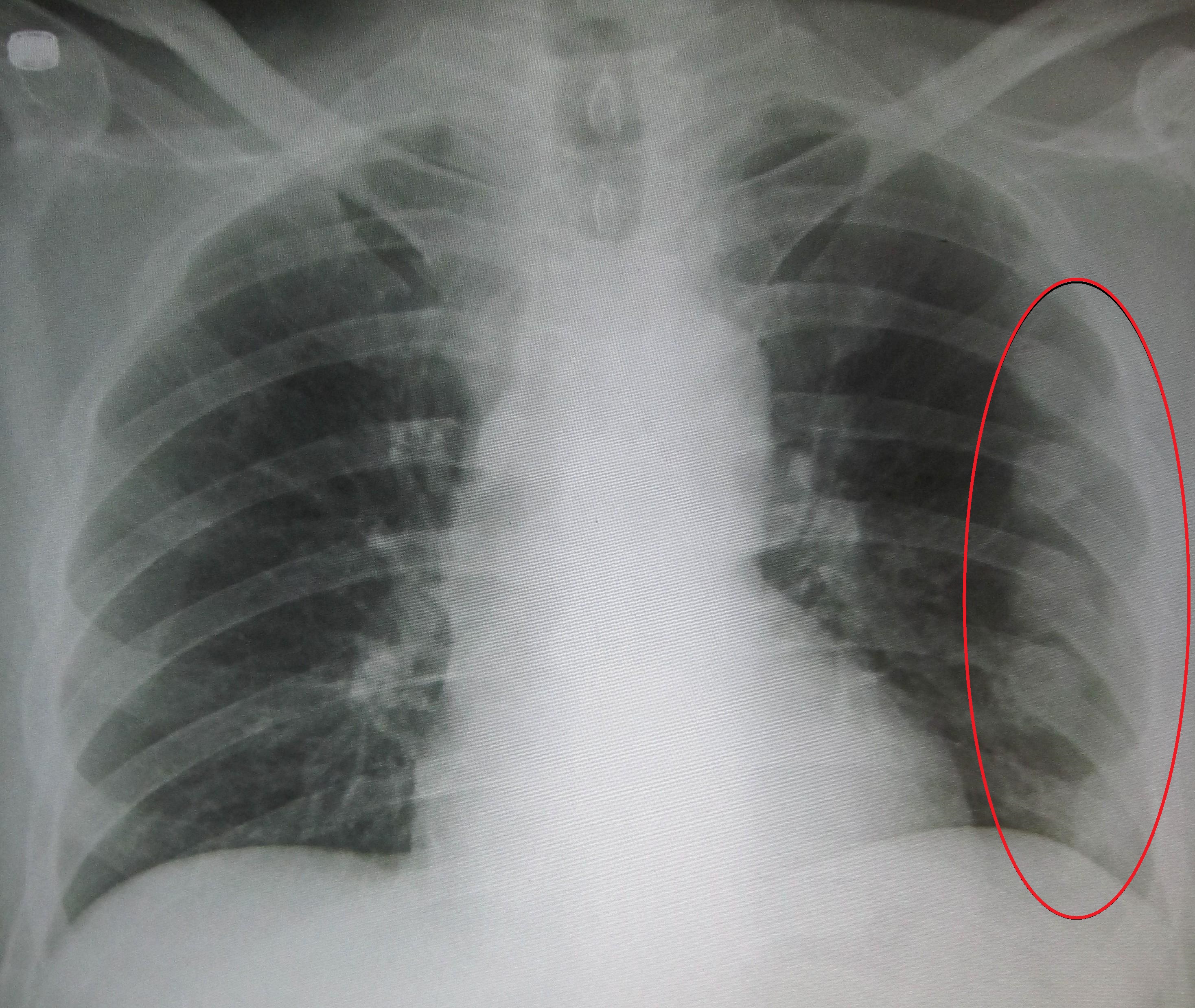Rib Fracture